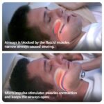 Smart Anti-Snoring Device Pro – Electronic EMS Muscle Stimulator for Better Sleep - Image 2